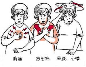 冠心病有哪些癥狀？(圖1)