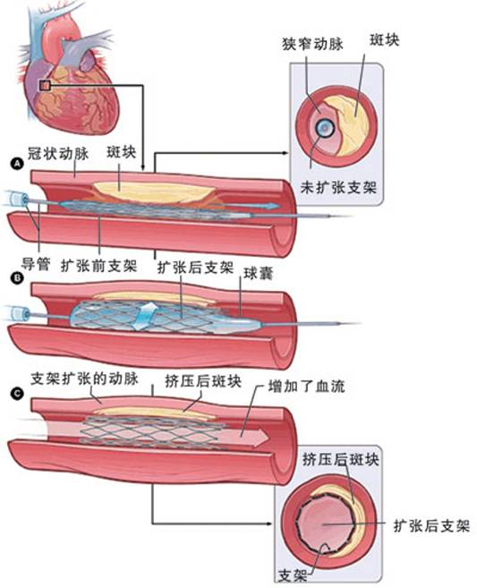 怎樣治療冠心?。?圖2)