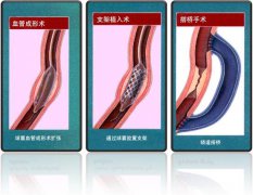 怎樣治療冠心??？