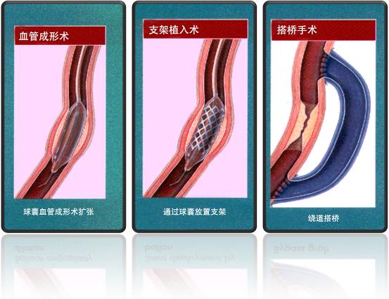 怎樣治療冠心??？(圖1)